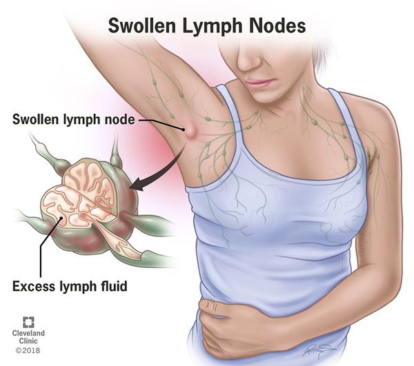 swollen armpit lymph nodes